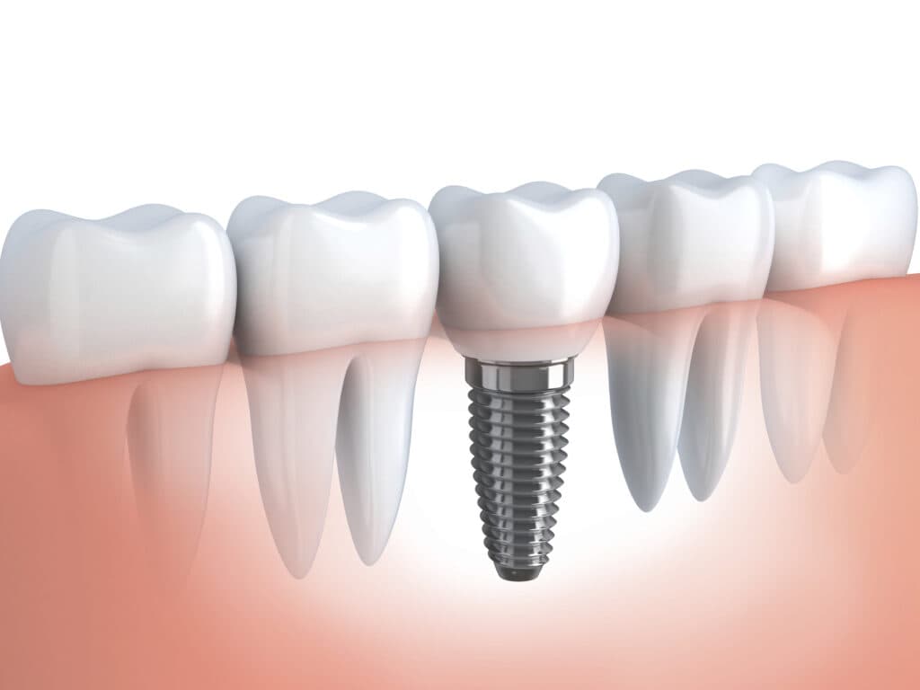 Implantes dentários — VIP Odontologia Morumbi, São Paulo