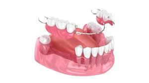 Prótese dentária — VIP Odontologia Morumbi, São Paulo